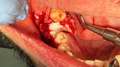 Conservation de la muqueuse attachée vestibulaire et linguale lors d’avulsions grâce à R.T.R.+ membrane