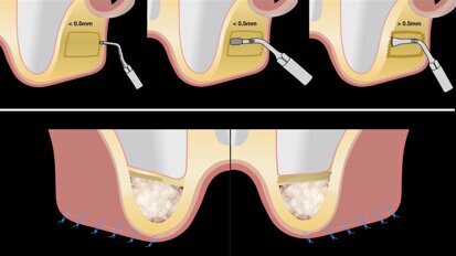 Piezocirugía  (9). Ventajas del piezoeléctrico en la terapia sinusal