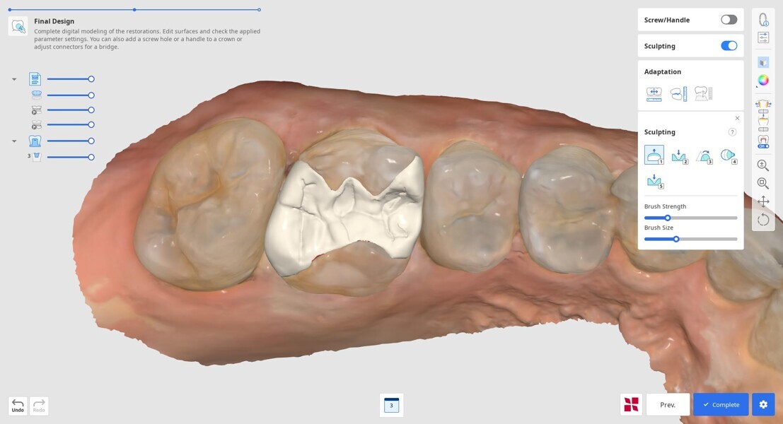 Fig. 8: Virtual design of the planned restoration in Medit ClinicCAD.
