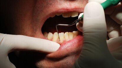 Nie każdy stan zapalny to paradontoza