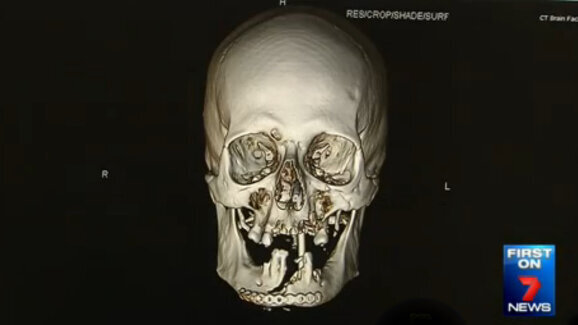 Australian surgeons repair man’s face after terrible chainsaw accident