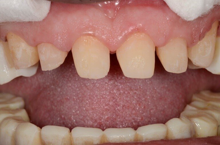 Fig 4: The presence of frosted enamel all over is a distinct advantage of these margins (Referred to as vertical preps)
