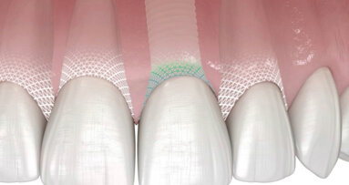 Patent Medical AG apresenta Symbionic Teeth