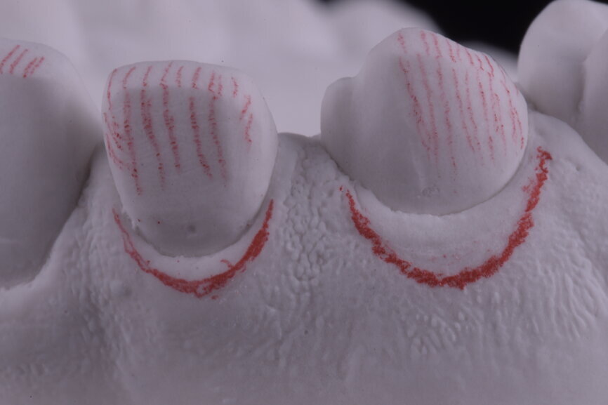 Fig. 46: Surgical silicone index for crown lengthening and cervical contours marked with a red pencil.