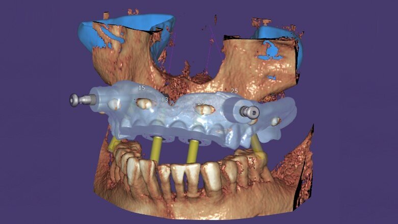 Il nuovo exoplan 3.0 Galway è ora disponibile