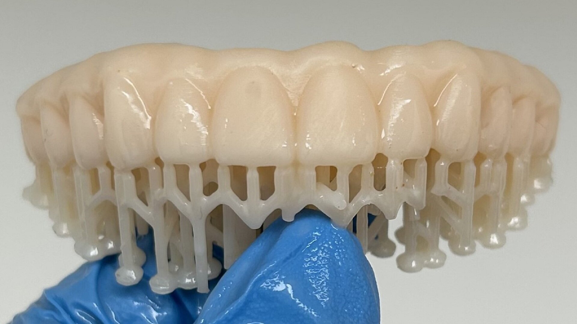 The use of inexpensive 3D printers to provide in-office solutions for immediate temporary restorations on implants