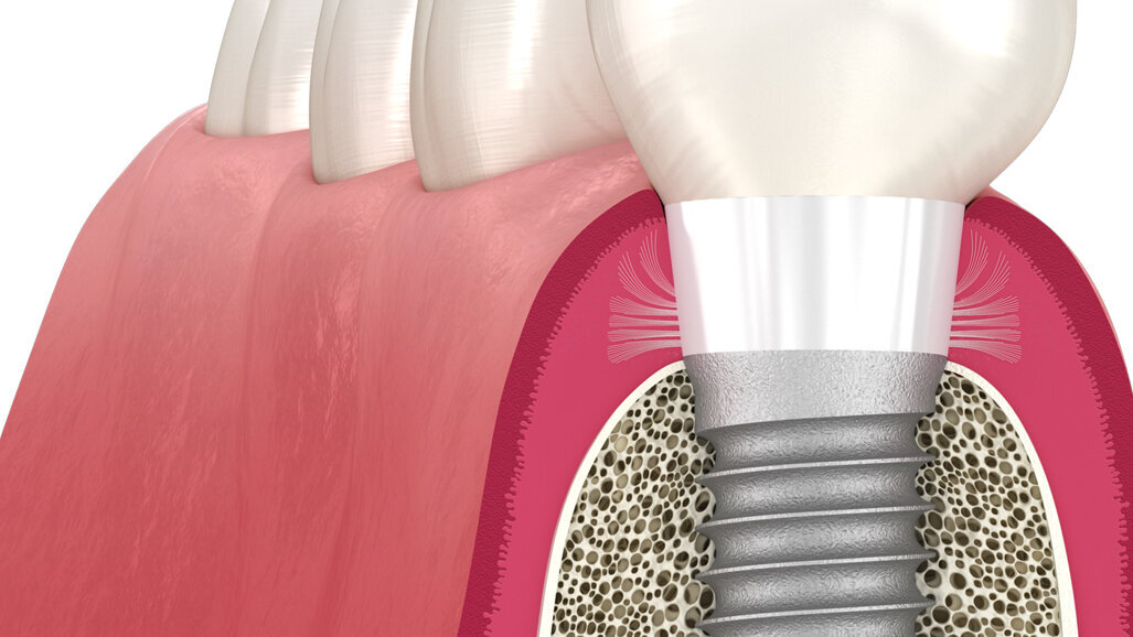 Livre blanc : comment favoriser une adhésion tissulaire naturelle en implantologie ?