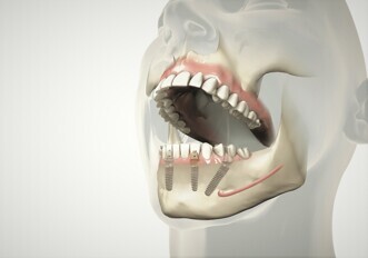 bredent – SKY fast & fixed