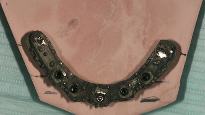 Fig. 3. Barra de Duralay® OSU, modelo rígido donde se fabrica la barra y barra metálica colada. Fig. 3. Barra de Duralay® OSU, modelo rígido donde se fabrica la barra y barra metálica colada.