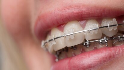 7 pytań o prostowanie zębów