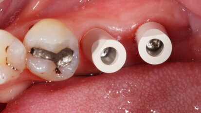 Mastering the implant digital workflow