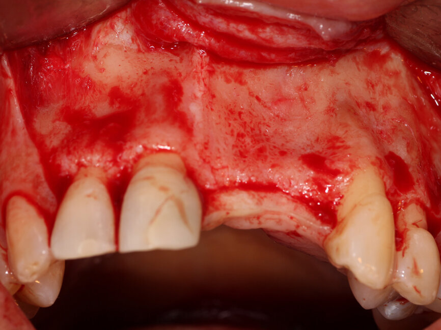 Fig. 3: A full thickness flap was created to expose the deficient facial aspect of the edentulous premaxilla that will receive augmentation to accommodate implant placement.