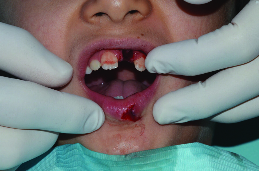 Figure 1: Initial presentation. 21 was avulsed and its socket appeared empty. There was a laceration of the lower lip