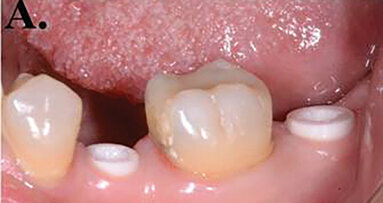 The future of implants: Advanced grade zirconia, the real strength