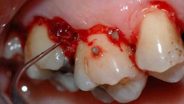 Protocolli  di trattamento parodontale non chirurgico
