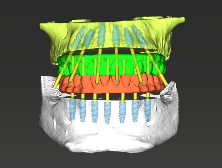 Fig. 9: 3DDX virtual treatment plan for the maxilla and mandible.