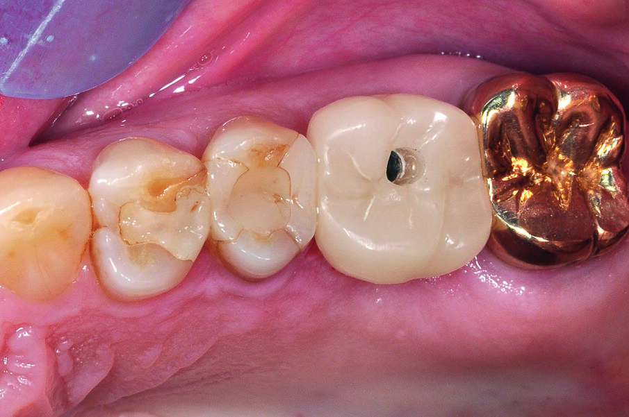 Fig. 14: The abutment crown with open screw channel that was screwed in immediately afterwards.