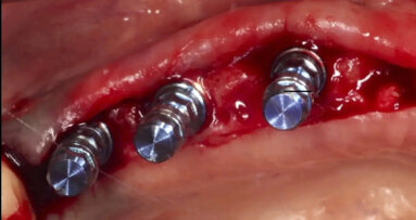 Efecto de la vitamina D en la osteointegración de los implantes dentales