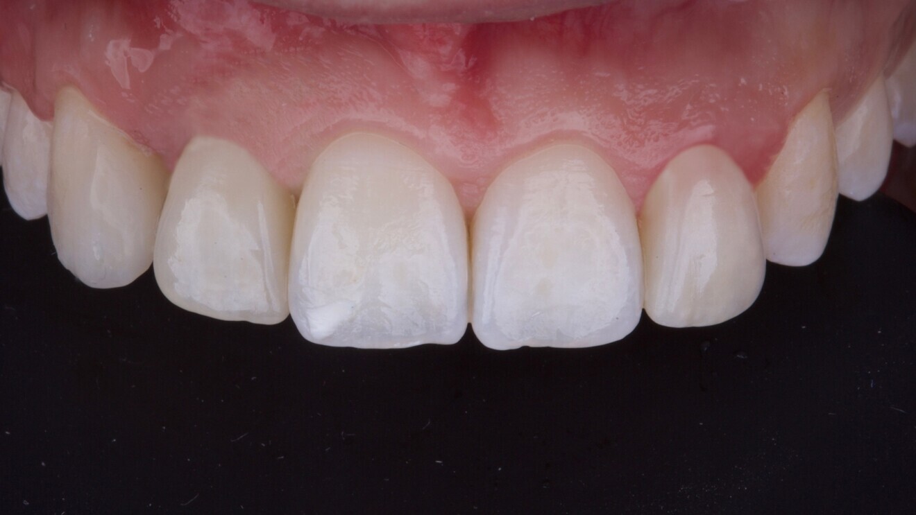 Fig. 9: Definitive prosthesis delivery: porcelain-veneered zirconia crown cemented on to a titanium link abutment.