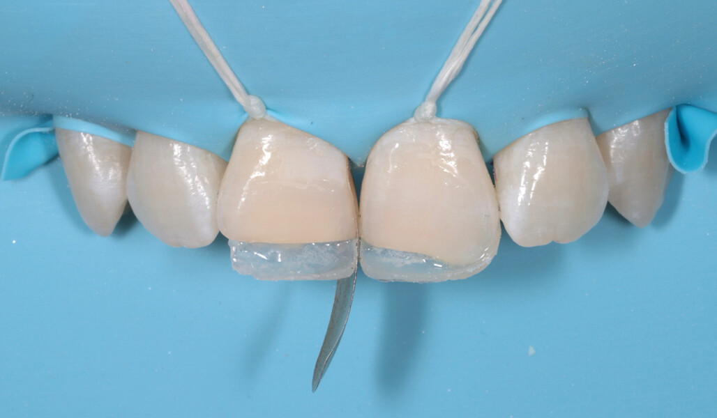 Fig. 10: Palatal enamel layer created with CLEARFIL MAJESTY ES-2 Premium.