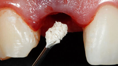 Four questions on Straumann biomaterials