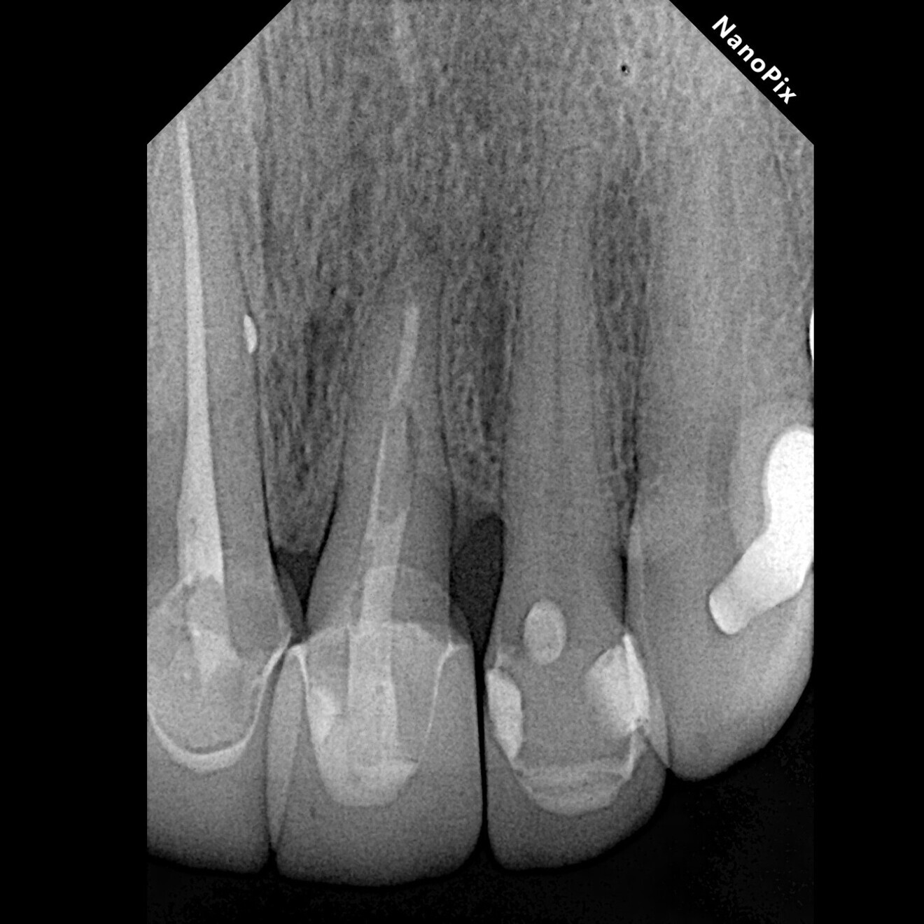 Fig. 5: Two-year follow-up radiograph showing periapical healing and signs of bone remodelling, mainly vertical bone growth in the distal area.