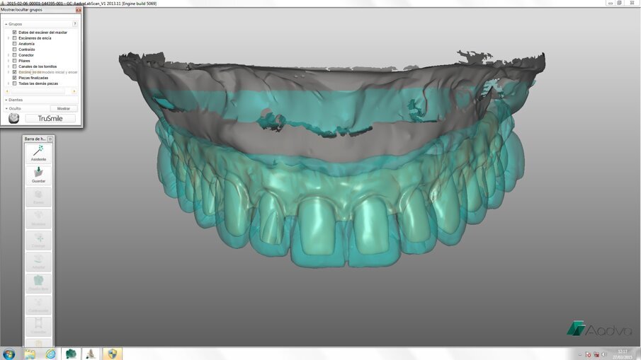 Fig. 8: Framework design in GC’s exocad software.