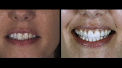 Abordaje clínico perio-estético-restaurador