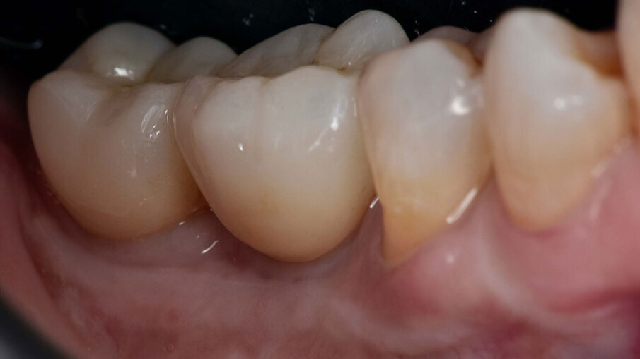 Figg. 19a, 19b_Immagine clinica e radiografica che mostrano il manufatto protesico finale.