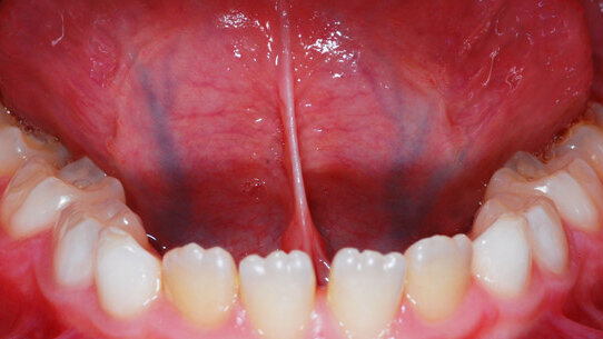 Analisi della variazione posturale cervicale prima e dopo la frenulotomia linguale laser