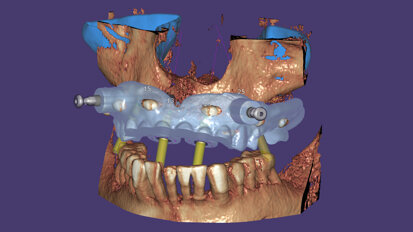 Nuevo exoplan 3.0 Galway ahora disponible