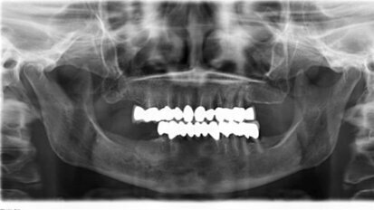 Impianti in paziente con terapia farmacologica per infiammazione renale e inizio di osteoartrosi: cortisoni a lungo termine