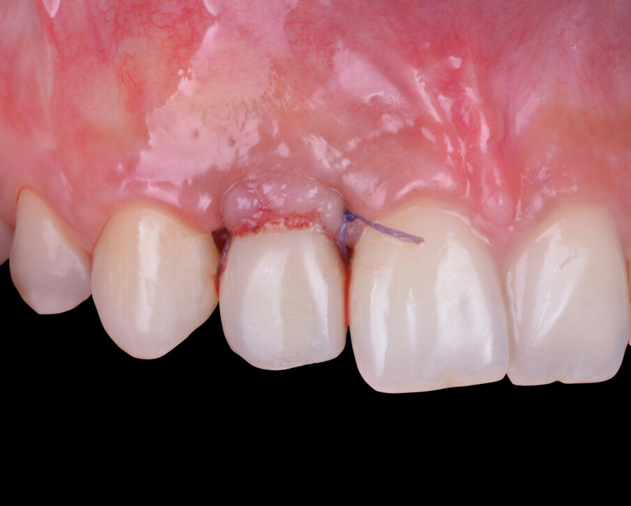 Fig. 12 - Corona provvisoria avvitata in situ.
