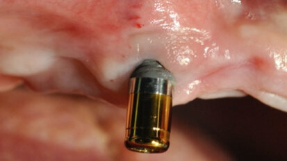 La corrosion des implants dentaires : facteur de risque des péri-implantites. Les implants zircone une alternative préventive