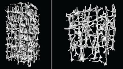 Osteoporosi e bisfosfonati