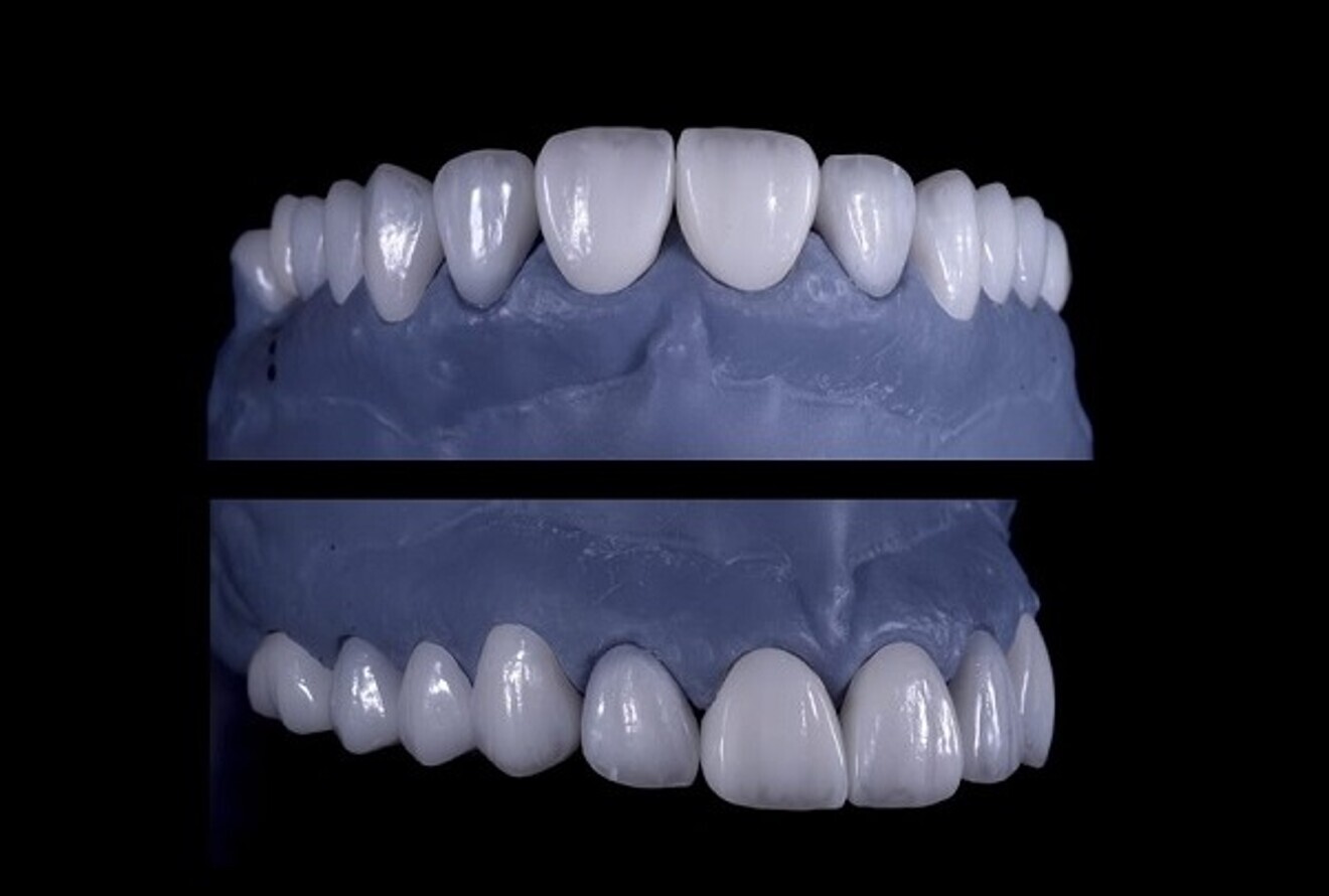 Fig. 6: Final lithium disilicate restorations.