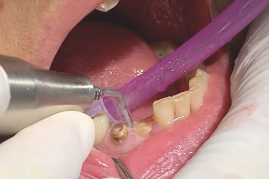 Figs. 4. Uso de los finos insertos para crear espacio entre hueso, ligamento y diente.
