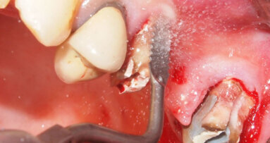 Gli strumenti sonici in odontostomatologia