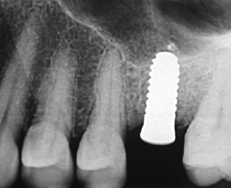 Fig.10 : Fin du traitement chirurgical. Implant deux pièces en céramique au niveau tissulaire. 