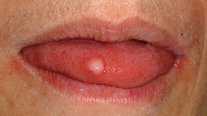 Fibrome in der zahnärztlichen Chirurgie – mit dem Laser einen Schnitt voraus Fibrome in der zahnärztlichen Chirurgie – mit dem Laser einen Schnitt voraus