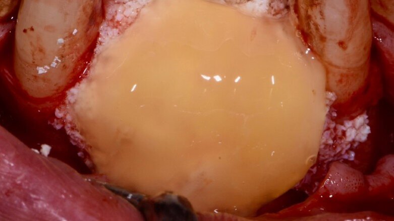 Flusso digitale CAD/CAM in implantologia a carico immediato 3.0