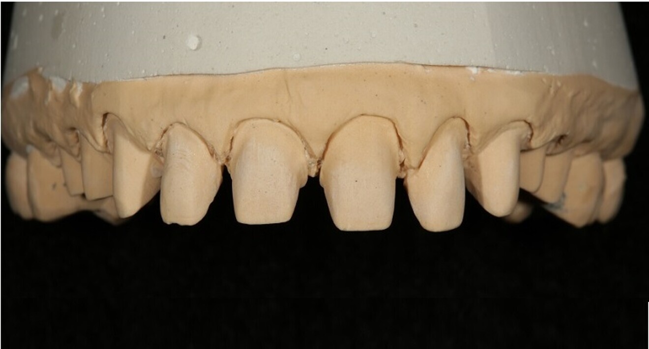 Fig. 3: Poured master impression.