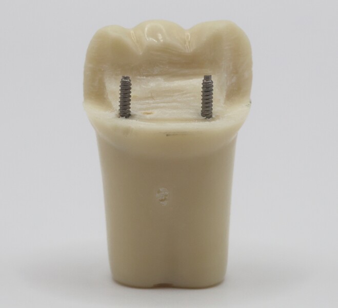 Fig. 7a: Completed pinlay preparation on tooth #36 after removal from the dentoform arch, shown in lingual view.