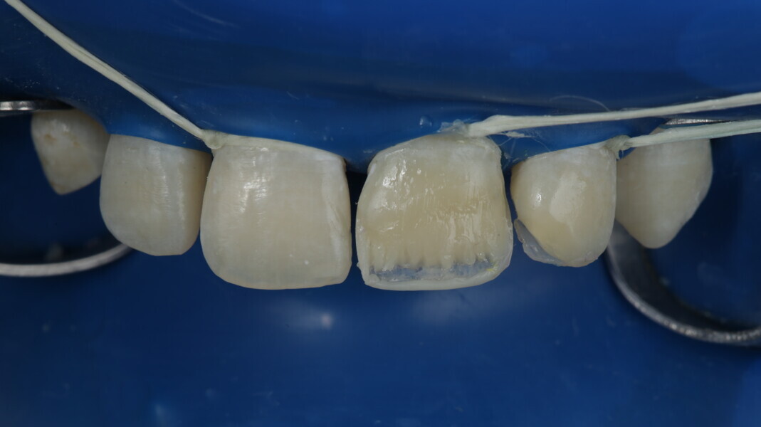 Fig 29: Clear Translucent was used to fill the space between the incisal edge and the mamelons in order to increase the translucency at the incisal third.  