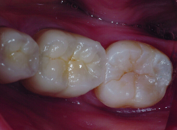 Fig.5 : Vue occlusale post-opératoire. 