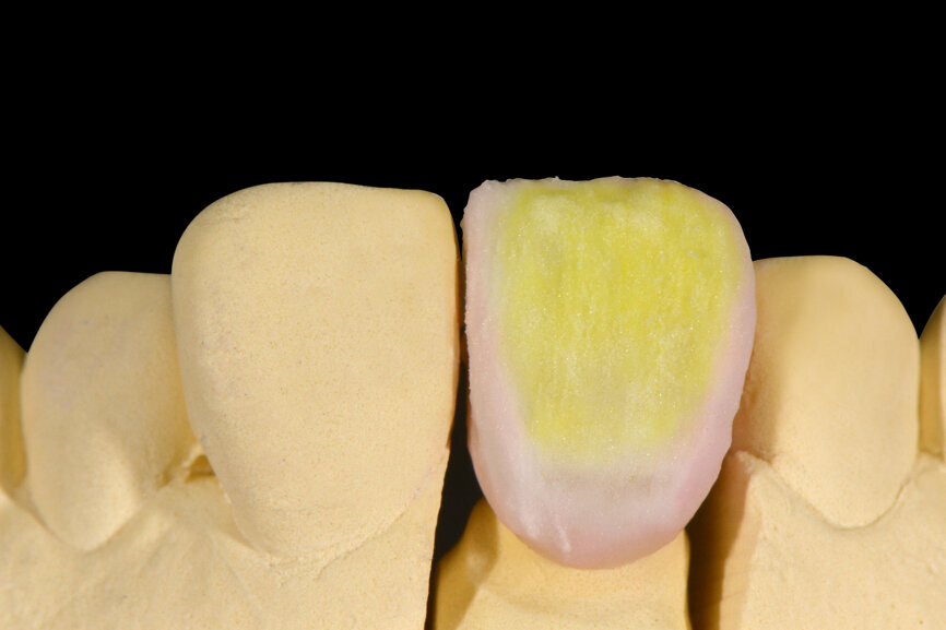 Fig. 9. Efecto halo de EE2 y BASE DENTINE. Finalización mediante capas finas de ENL, END y WIN.