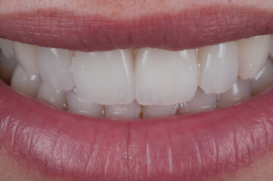 Figg. 20-23 - Restauro definitivo con tutti i dettagli della texture sui restauri in bocca.