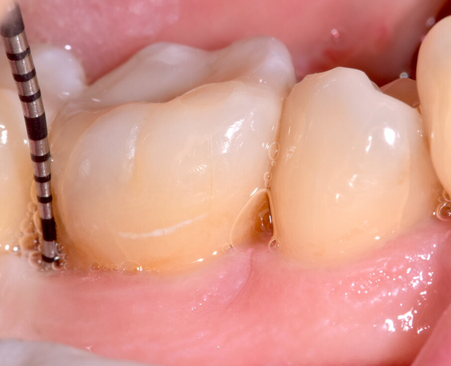 Fig. 14 - Maturazione dei tessuti e sondaggio a 3 mesi.