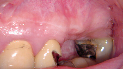 Apical microsurgery: sutures, suturing techniques (Part 6) Apical microsurgery: sutures, suturing techniques (Part 6)