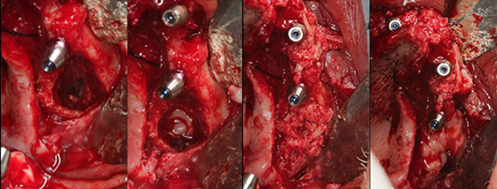 Fig. 16. Vista de la comunicaciÃ³n orosinusal una vez retirado todo el material de injerto contaminado y el tejido inflamatorio. Fig. 17. Se utilizan tapones y membranas de A-PRF para el cierre de la comunicaciÃ³n. Fig. 18. El defecto Ã³seo se rellena con hueso autÃ³logo, asÃ­ como el resto de los defectos periimplantarios. El hueso fue obtenido durante la regularizaciÃ³n Ã³sea con pinza gubia. Fig. 19. El injerto es cubierto con membranas de A-PRF.